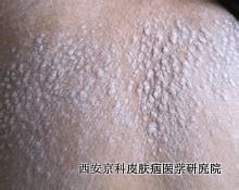 什么是牛皮癣症状