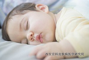 预防儿童牛皮癣的方法