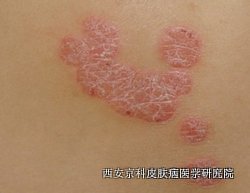治疗期间牛皮癣有哪些要注意