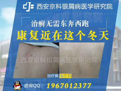 郑州皮肤病治疗最好的医院